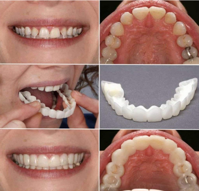 😁 INSTANT PERFECT SMILE – KOZMETIČKE NAVLAKE ZA ZUBE 2U1, GORNJA I DONJA VILICA! ✨🦷