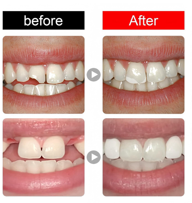 😁 SNAP-ON VENEERS – PODESIVE KOZMETIČKE NAVLAKE ZA ZUBE, GORNJA I DONJA VILICA!