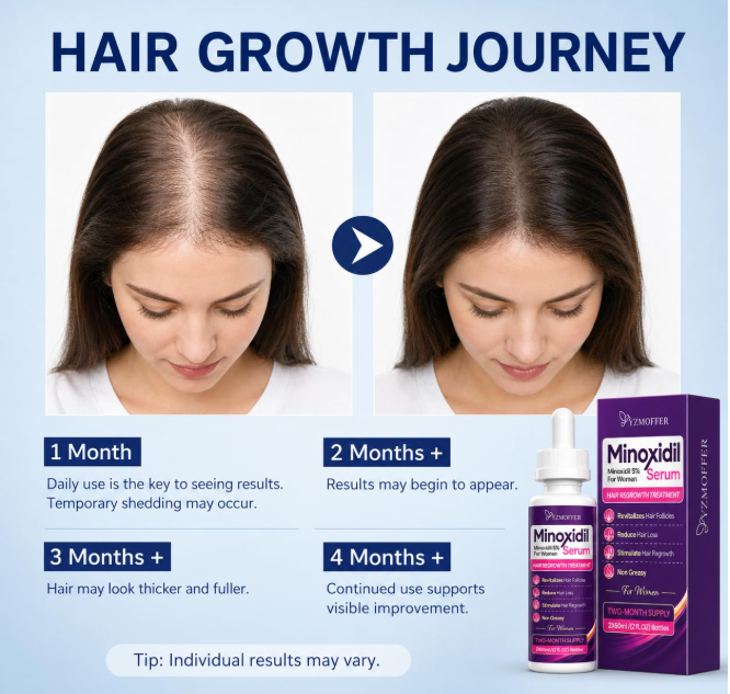 🌸 MINOXIDIL 5% – TRETMAN ZA PONOVNI RAST KOSE KOD ŽENA! 💆♀️✨