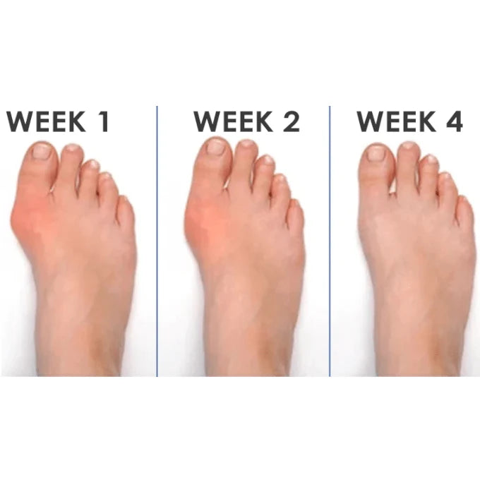 Profesionalni ispravljač Korektor za Nožne Prste