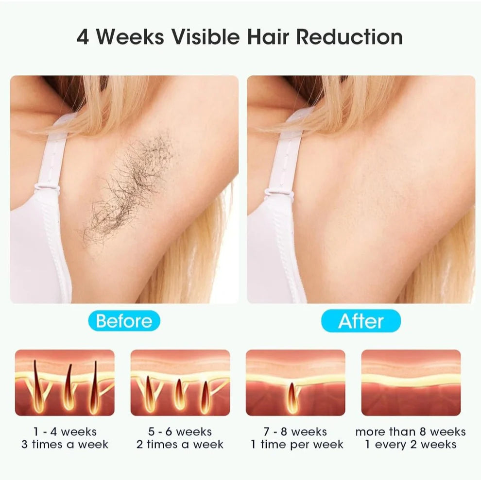 Uređaj za Lasersku Epilaciju s Ledenim Učinkom